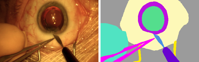 Segmentation example from cataract datasets